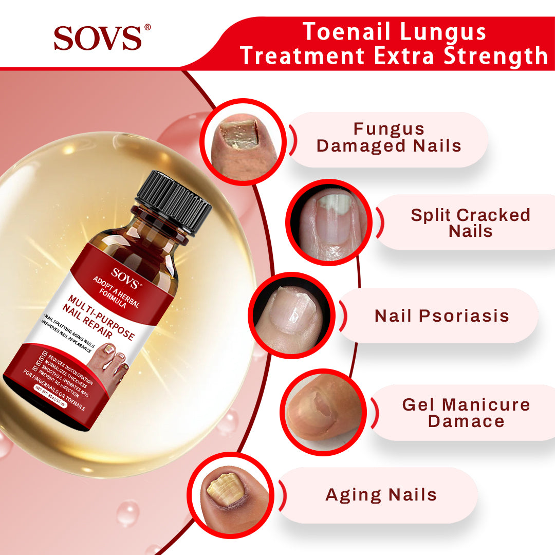 SOVS Toenail Treatment,Gentle Formula, Effectively Improves Nails for a More Beautiful Appearance（30ml）