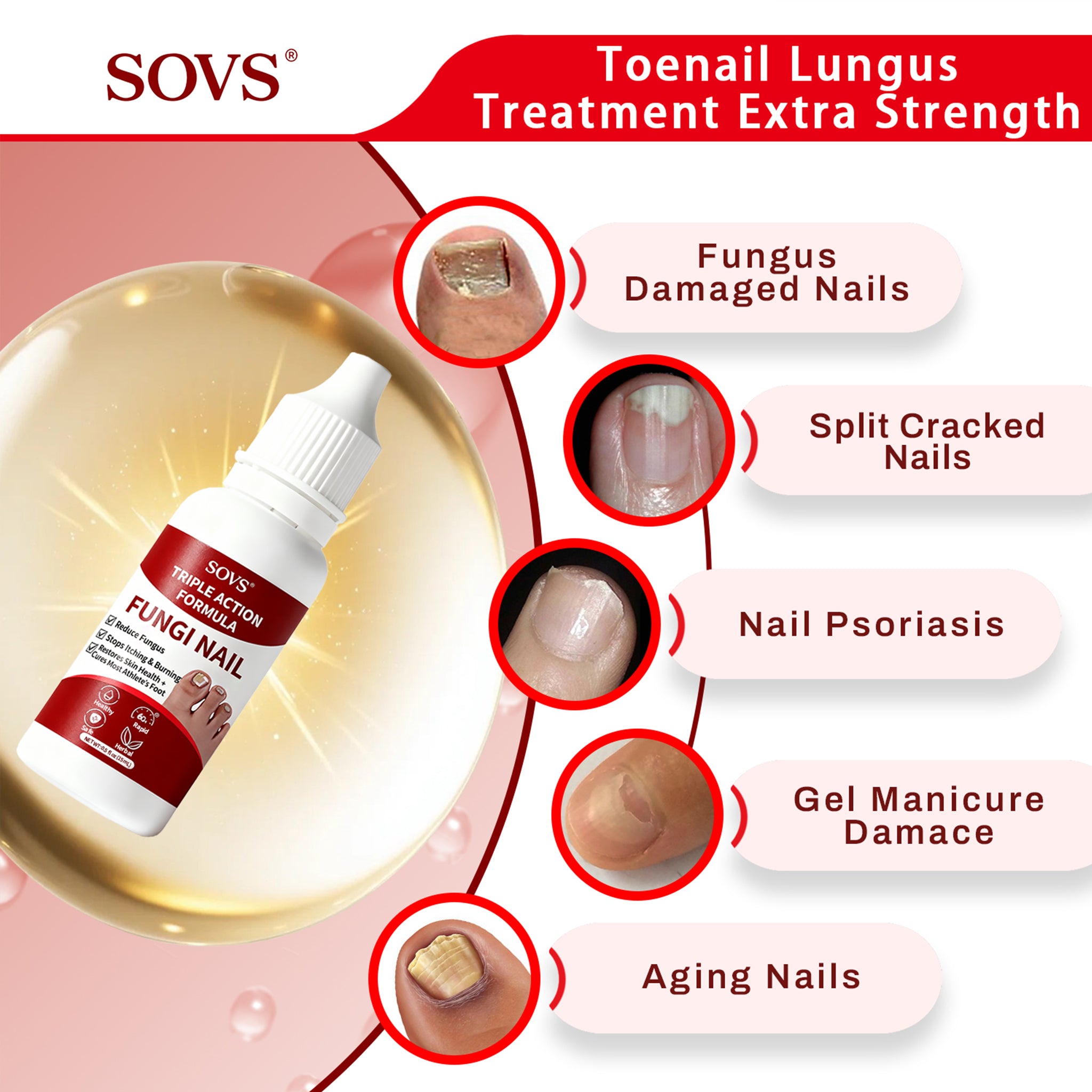 SOVS Toenail Treatment,Gentle Formula, Effectively Improves Nails for a More Beautiful Appearance