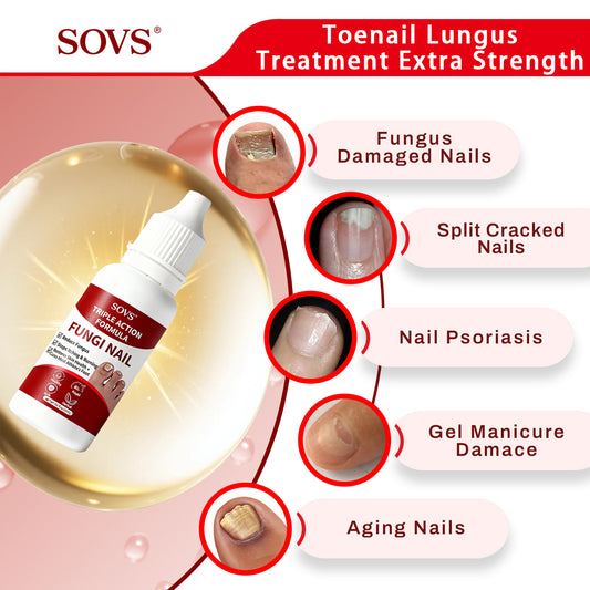 SOVS Tolnaftate Nail Fungus Solution | For Fingernails & Toenails