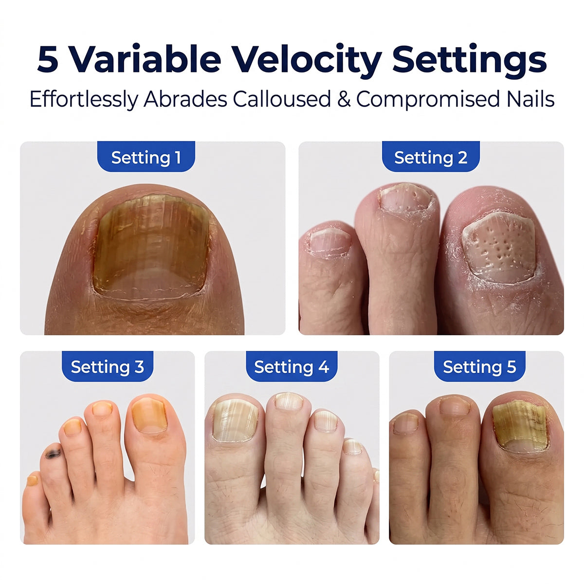 5 variable speed velocity settings on electric nail drill shown across different calloused and damaged toenails.