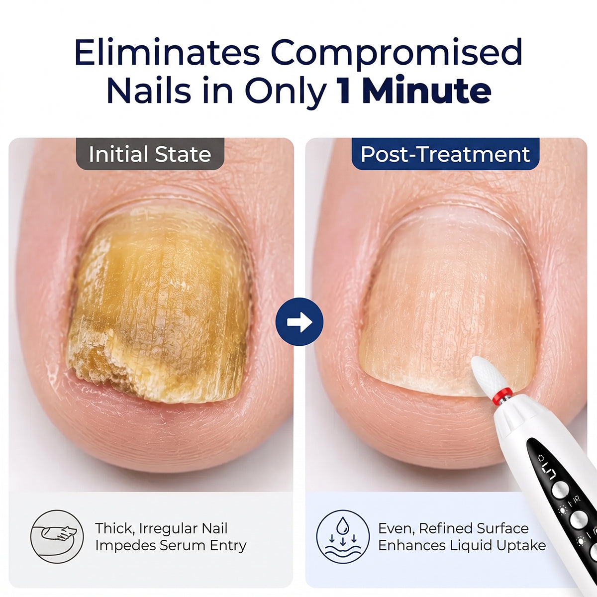 Before and after comparison of thick damaged fingernail treated with electric nail file for smoother surface.