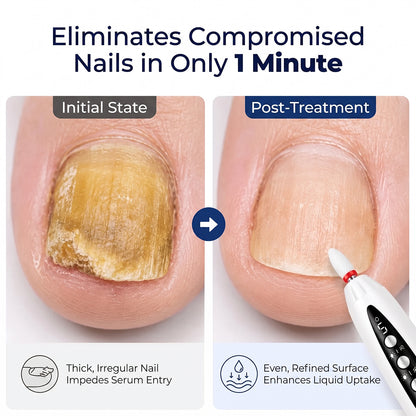 Before and after comparison of thick damaged fingernail treated with electric nail file for smoother surface.