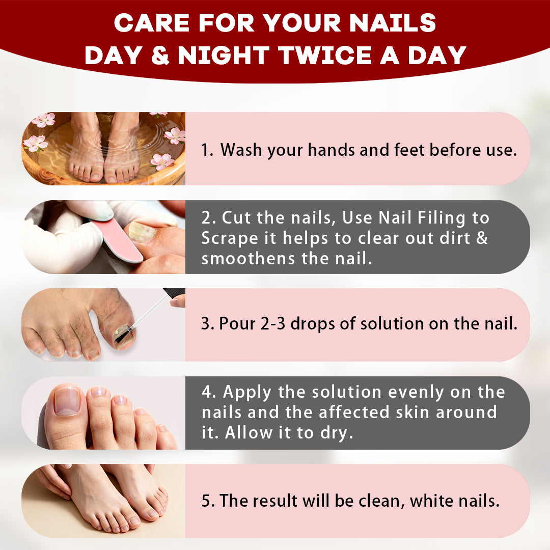 How to apply SOVS Tolnaftate nail fungus treatment solution to affected nails