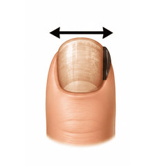 Nail Separation