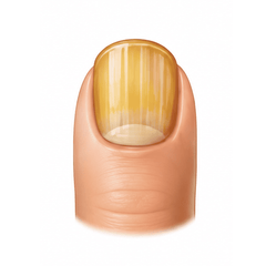 Yellowing Nails
